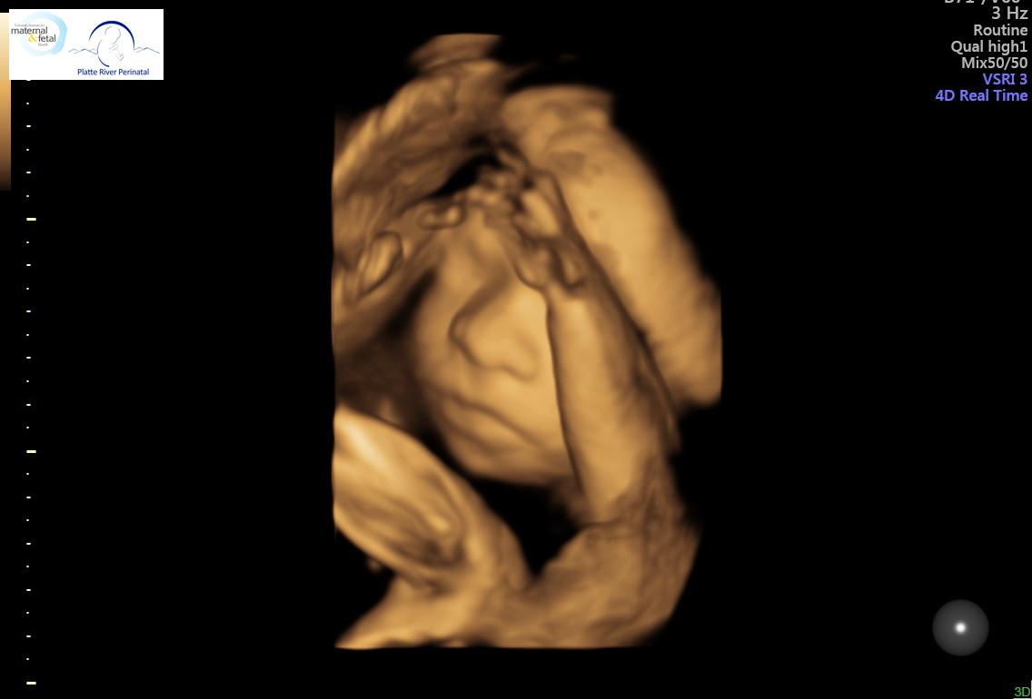 My Braverman miracle is happe…